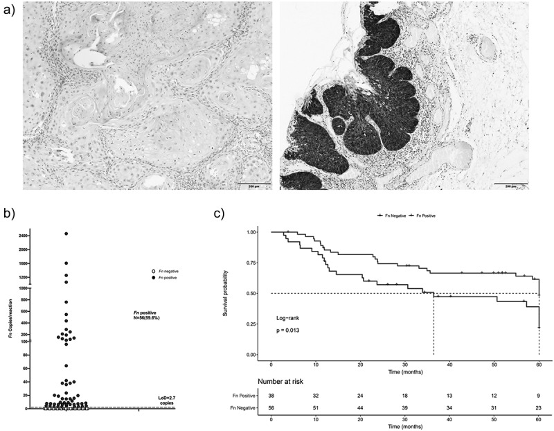 Intratumoral <i>Fusobacterium nucleatum</i> is associated with better cancer-specific survival in head and neck cancer patients.