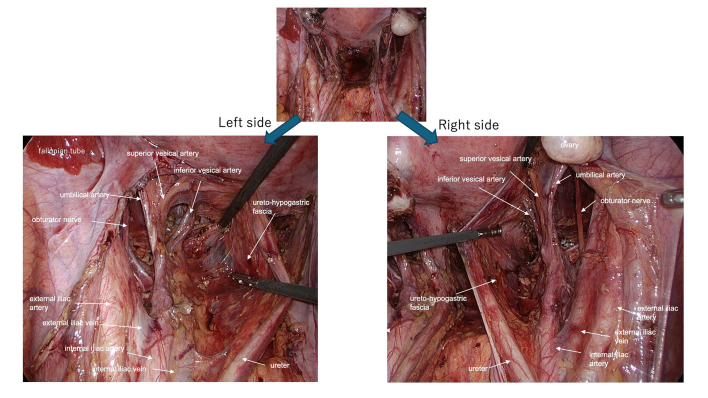 Short-term Outcomes of Robotic Lateral Pelvic Lymph Node Dissection for Lower Rectal Cancer.