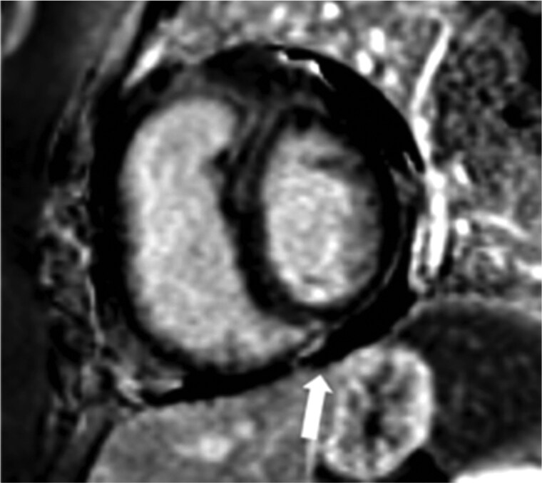 Non-invasive imaging in acute and chronic pulmonary embolism.