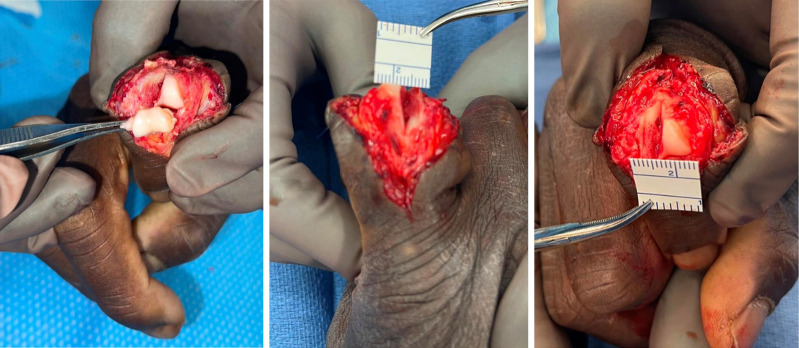 Osteochondral autograft from the second toe for complex proximal interphalangeal joint fracture-dislocations: a case report and literature review.