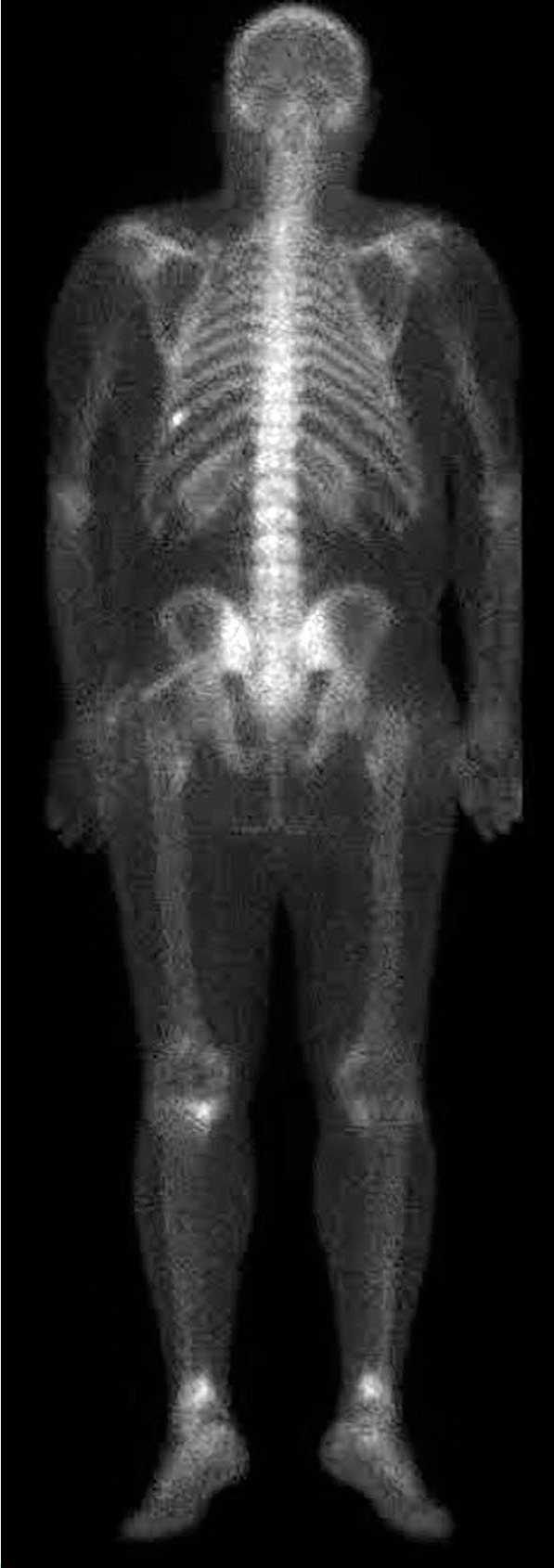 A rare cause of knee pain: Multiple intraosseous lipomas mimicking bone metastasis.