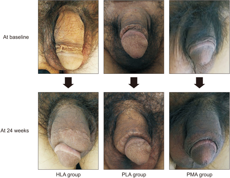 Which Dermal Filler is Better for Penile Augmentation for Aesthetic Purposes? A Prospective, Single-Surgeon Study Based on Real-World Experience.