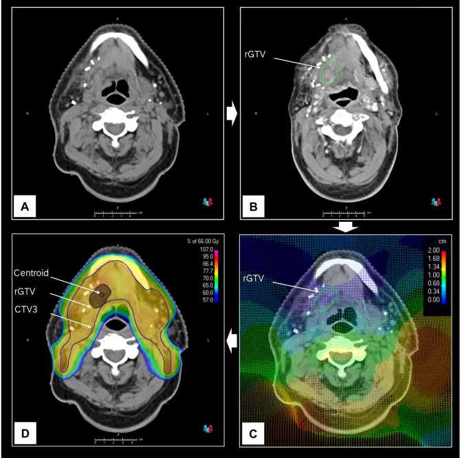 Combined Spatial and Dosimetric Recurrence Pattern Analysis in Head and Neck Squamous Cell Carcinoma Following Postoperative (Chemo)radiotherapy.