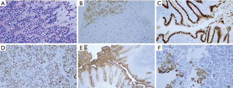 PIK3CA inhibitor treatment for metastatic scrotal extramammary Paget's disease: a case report and literature review.