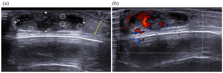 Pilomatricomas in a patient with Rubinstein-Taybi syndrome: diagnostic and therapeutic clues.