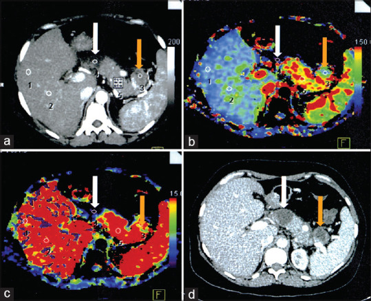 Early perfusion computed tomography in severe acute pancreatitis: Predicting necrosis and guiding care.