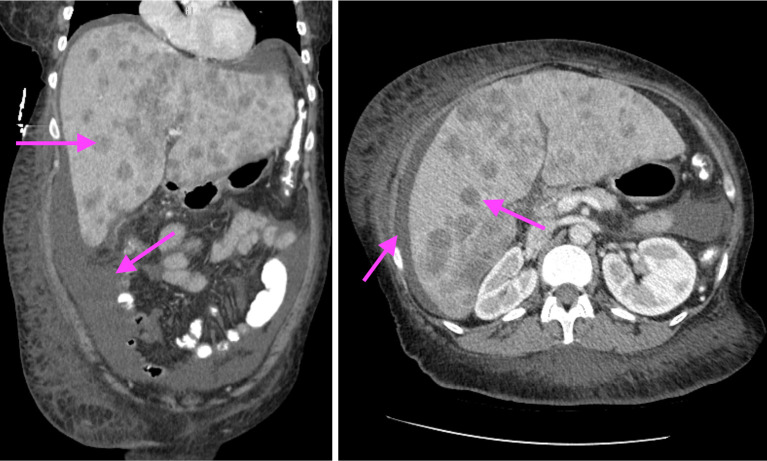 Humor me with calcium: a case report of humoral hypercalcemia of malignancy secondary to cholangiocarcinoma.