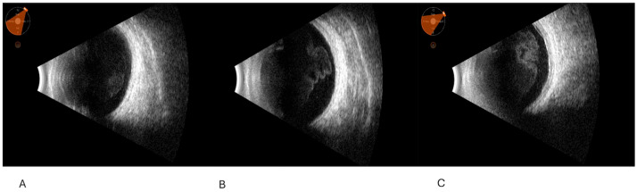 Ocular Ultrasound as a Key to Diagnosing Uveitis-Masked Syndromes: Tips and Tricks.