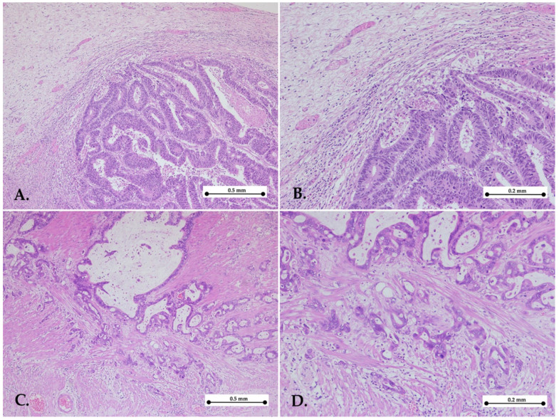 Prognostic Impact of Klintrup-Mäkinen (KM) Score in Gastric Cancer and Its Association with Pathological Parameters.