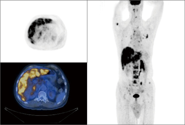 PIK3CA inhibitor treatment for metastatic scrotal extramammary Paget's disease: a case report and literature review.