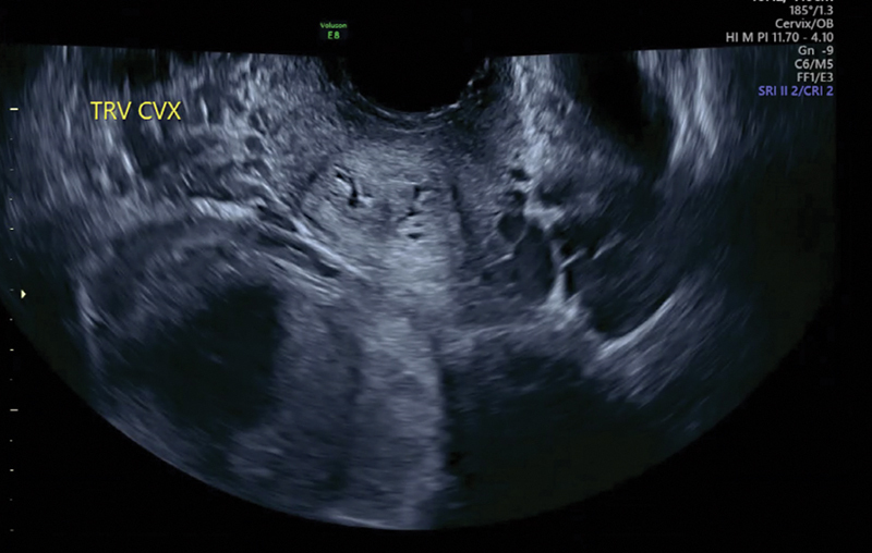 Di-Cavitary Twin Pregnancy in Didelphys Uterus with Associated Renal Agenesis.