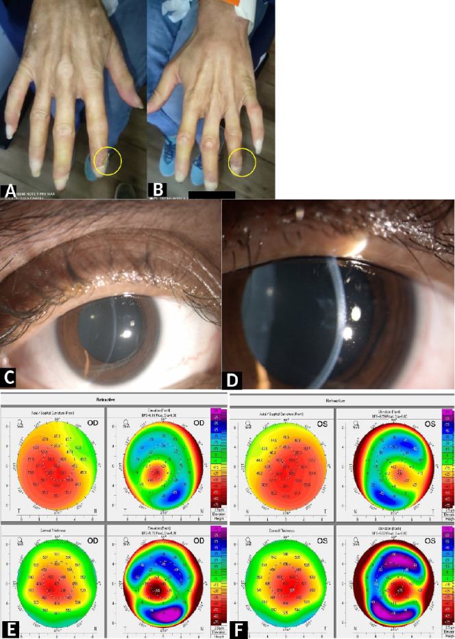 Bilateral Keratoconus in Diffuse Cutaneous Systemic Sclerosis: A Rare Presentation - Is There Any Role of Autoimmunity?
