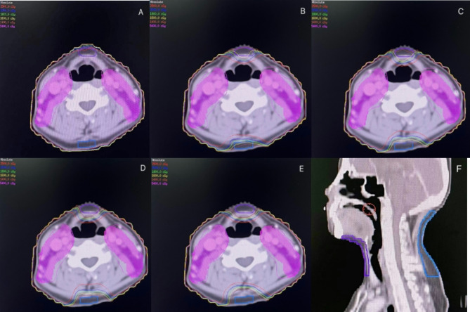 Neck dose-limiting rings reduce head and neck lymphedema in early nasopharyngeal carcinoma patients undergoing IMRT: a dosimetric-clinical validation.