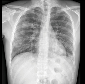 A Subtle Presentation of Pharyngitis and Pneumonia: Lemierre Syndrome.