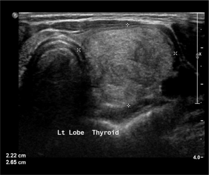 Comparative accuracy of fine-needle aspiration cytology between larger and smaller size thyroid nodules.