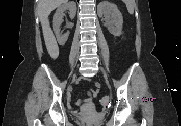 Recurrent Urosepsis Following Stent Removal for Ureteral Stones: A Case Report.