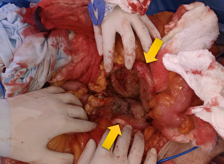 Ruptured abdominal aortic aneurysm and aortocaval fistula: a highly lethal find.