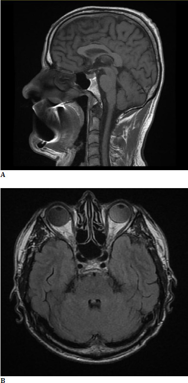 Pseudo Foster-Kennedy Syndrome in an amblyopic patient: a case report.