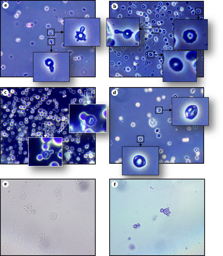 Glomerular Hematuria for the Diagnosis of Glomerulonephritis.