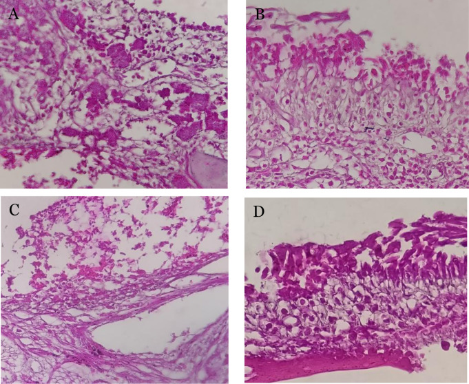 Therapeutic potential of thymoquinone in regulating p63, claudin, and periostin in chronic rhinosinusitis with nasal polyps: An animal model study.