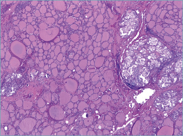 Evaluation of papillary thryoid carcinoma and its variants: multifocality in thyroid lobectomy and completion thyroidectomy - a single tertiary center retrospective study.