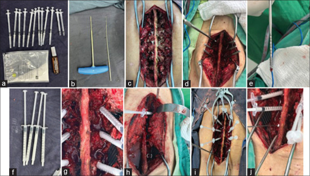 Polymethylmethacrylate augmentation of conventional pedicle screws in spine surgery - A modified classical method.