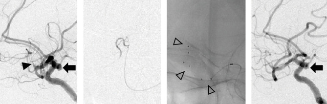 Mechanical Thrombectomy for Large Vessel Occlusion Strokes Involving a Cerebral Aneurysm in the Target Vessel: Case Series.
