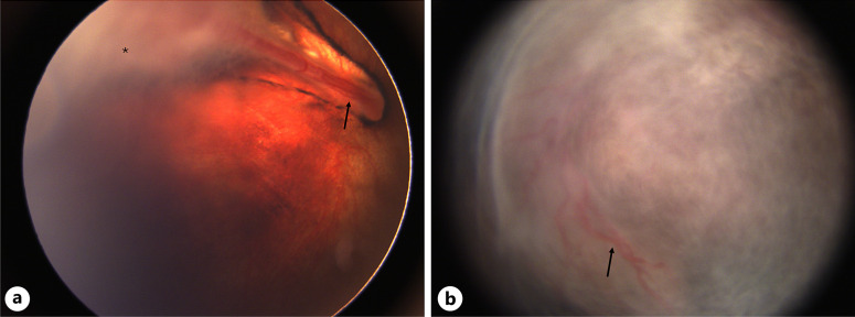Aqueous Humor Liquid Biopsy to Exclude Retinoblastoma for a Child with an Intraocular Mass.