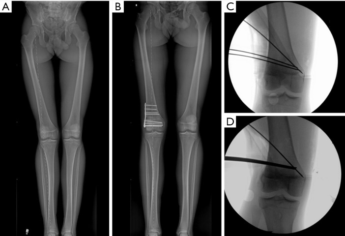Joint preservation procedures: osteotomies about the knee.