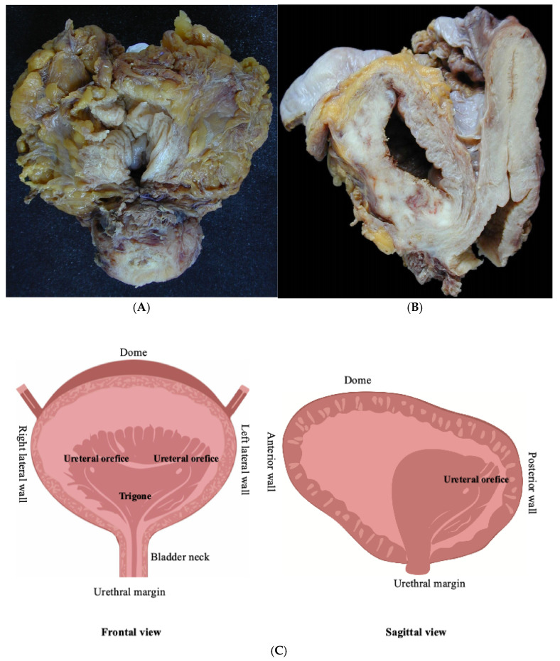 The Handling and Sampling of Radical Cystectomy Specimens: A Standardized Approach for Pathological Evaluation.