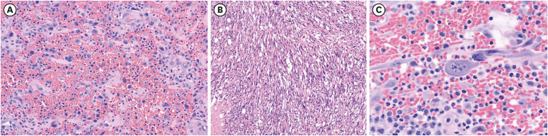 A Clinicopathologic Feature and Survival Analysis of Cutaneous Angiosarcoma: A Single Tertiary Center Study.
