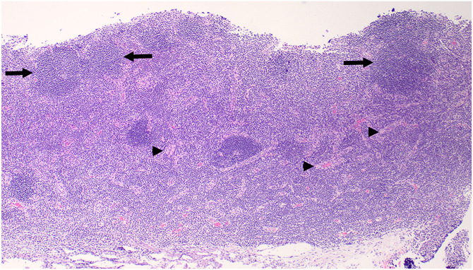 Clinicopathologic features and clinical outcome in a cat with nodal T-zone lymphoma.