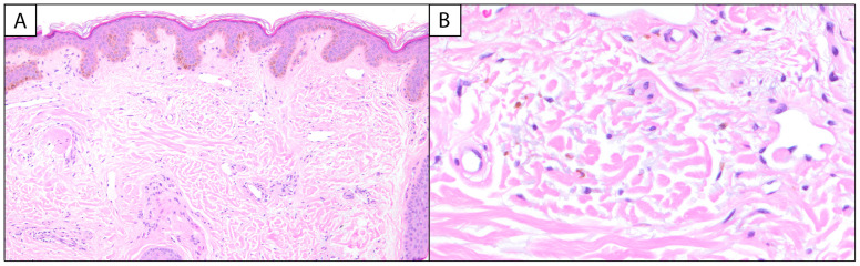 A Scoping Review on Melasma Treatments and Their Histopathologic Correlates.