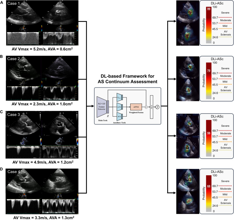 Utilizing deep learning for accurate assessment of aortic valve stenosis: case series for clinical applications.