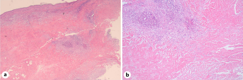 Successful Treatment of Necrobiosis Lipoidica with Abrocitinib: A Case Report.