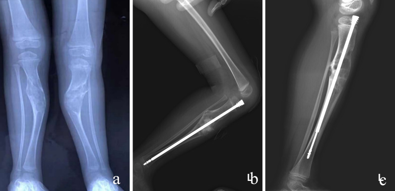 Feasibility of non-radical resection combined with internal fixation for adolescents with lower limb fibrous dysplasia: a single-center retrospective study with a small sample size.
