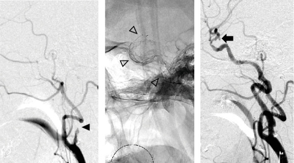 Mechanical Thrombectomy for Large Vessel Occlusion Strokes Involving a Cerebral Aneurysm in the Target Vessel: Case Series.