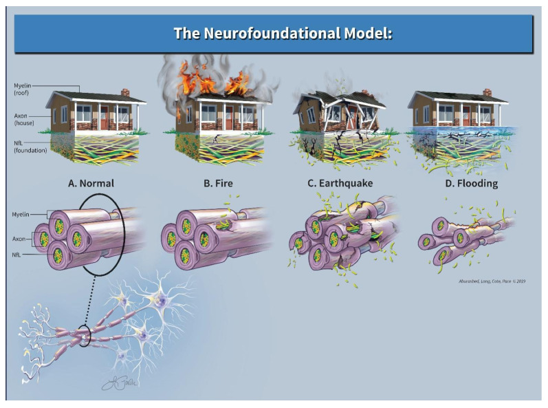 Neurofilament Light Chain and Multiple Sclerosis: Building a Neurofoundational Model of Biomarkers and Diagnosis.