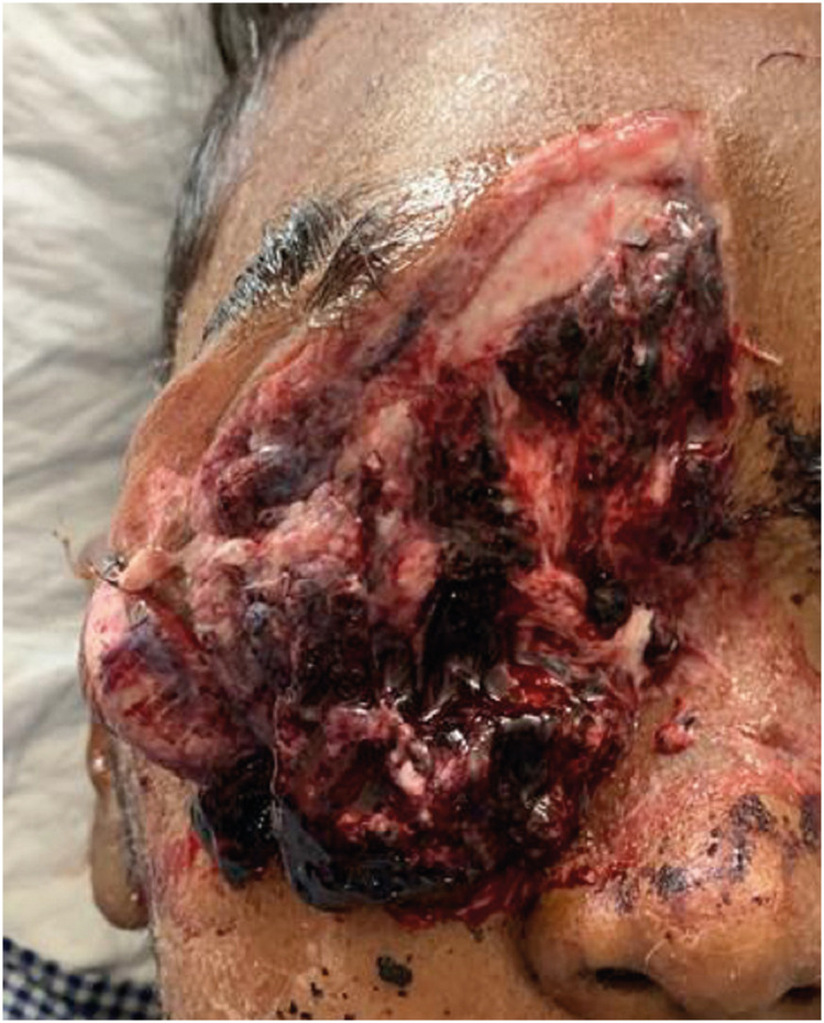 Agricultural Farm-Related Head Injuries in Rural India: A Case Series.