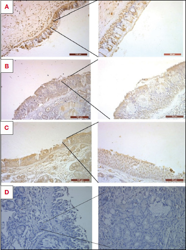 The impact of the bitter taste receptor on the predisposition to chronic rhinosinusitis.