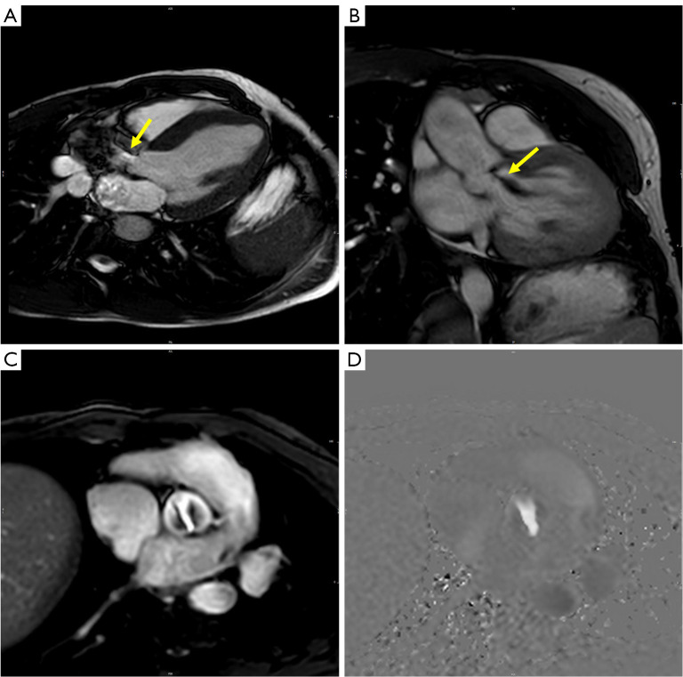 Cardiovascular magnetic resonance and valvular heart diseases: a suggested protocol for congenital lesions.
