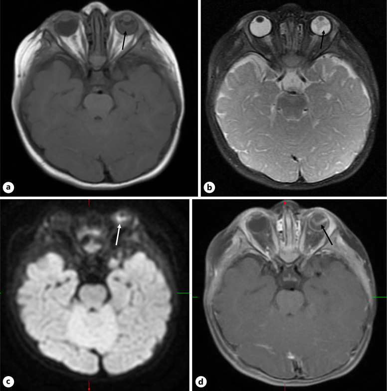 Aqueous Humor Liquid Biopsy to Exclude Retinoblastoma for a Child with an Intraocular Mass.