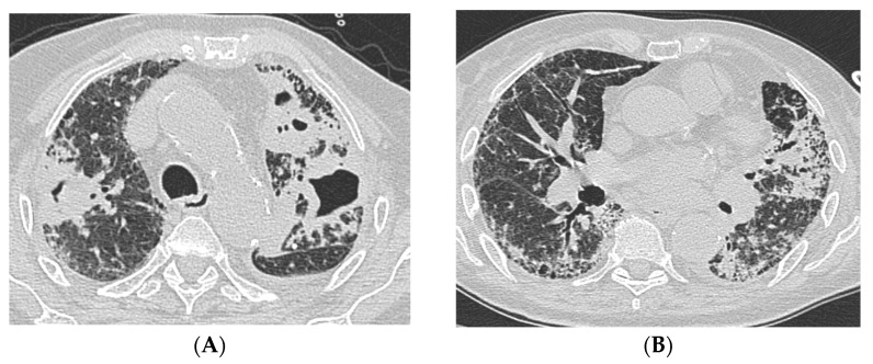 Usual Interstitial Pneumonia Pattern and Mycobacteria Lung Diseases: A Case Series.