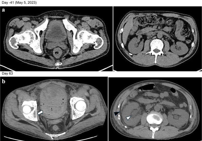 Combined Impact of Prior Polatuzumab Vedotin Plus Bendamustine and Rituximab Therapy and Myeloablative Conditioning on Early Post-Transplant BK Virus-Associated Hemorrhagic Cystitis.