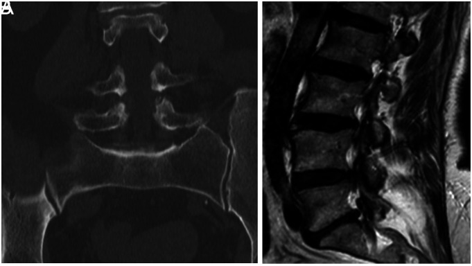 Presence of sacralized lumbar vertebra predisposes to adjacent level lumbar disc degeneration: A cross-sectional study.