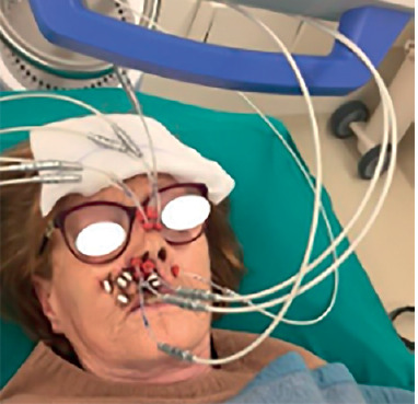 Quality control strategies for head and neck brachytherapy (interventional radiotherapy).