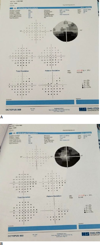 Pseudo Foster-Kennedy Syndrome in an amblyopic patient: a case report.