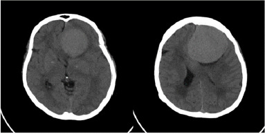 Foster Kennedy Syndrome from Frontal Lobe Meningioma: A Rare Case Report.