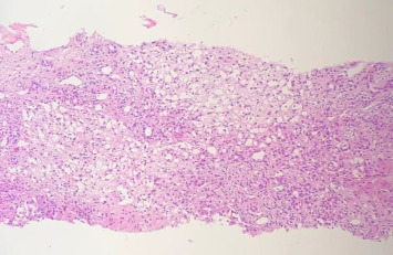 COVID-19 Challenges in Autoimmune Hepatitis Management: A Successful Outcome With Intravenous Immune Globulin (IVIg).
