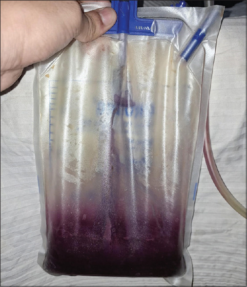 Purple Urine Bag Syndrome in a Bedridden Postmenopausal Woman.